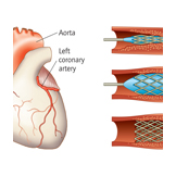heart stent