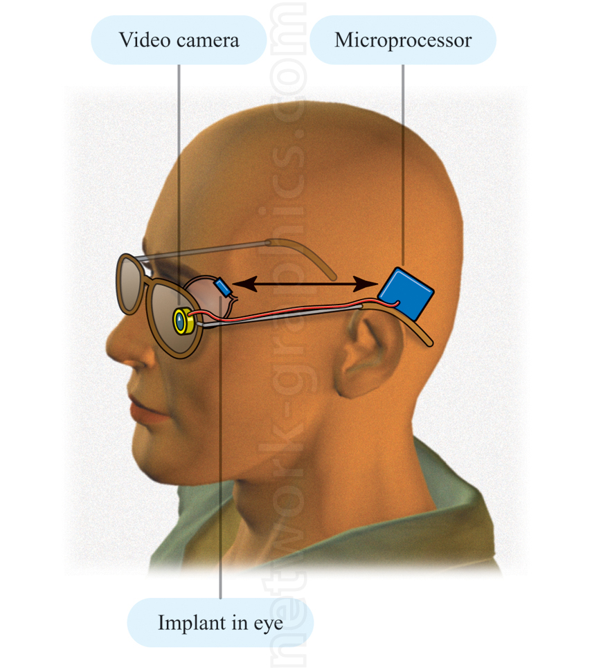 Illustration of a visual prosthetic system showing a video camera on glasses, a microprocessor, and a retinal implant transmitting signals to the eye for artificial vision.