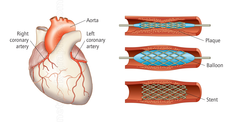 Anatomical illustration of the human heart showing aorta, right and left coronary arteries, alongside cross-sectional views of a coronary artery stent procedure with plaque, balloon angioplasty, and stent placement.